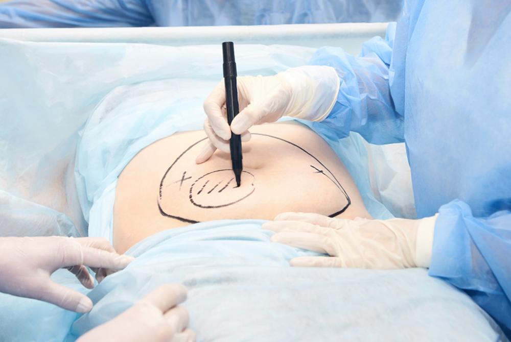 Choosing a Colon and Rectal Surgeon